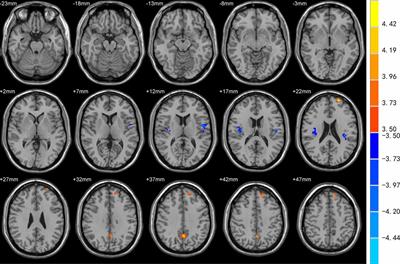 Distinct Changes in Global Brain Synchronization in Early-Onset vs. Late-Onset Parkinson Disease